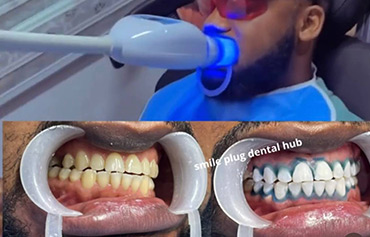 Teeth Whitening