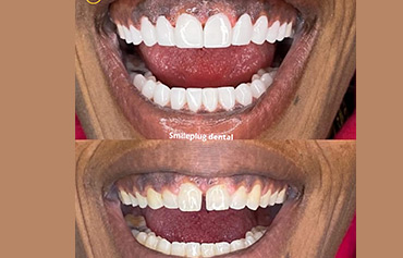 Dental Veneers