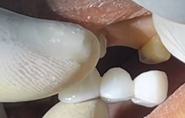 Permanent Tooth Replacement