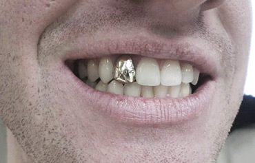 Gold/Silver Tooth