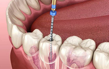 Root Canal Treatment (RCT)