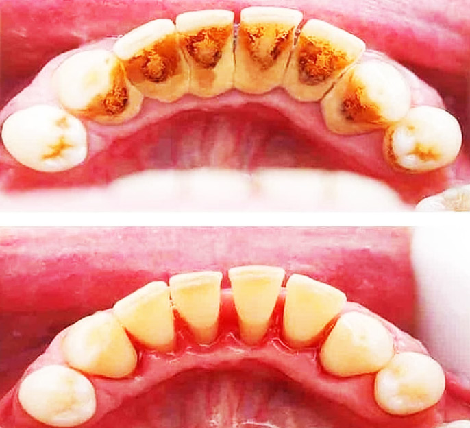 scaling-and-polishing-smileplug.com.ng